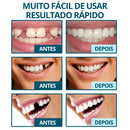 Facetas Dentárias Naturais Removíveis PerfetctSmile One | Seu sorriso perfeito em poucos minutos