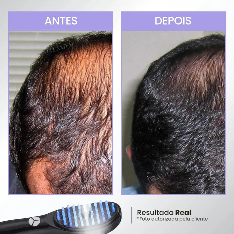 Escova de Terapia Capilar TheraBrush | Reduz a queda de cabelo e caspa